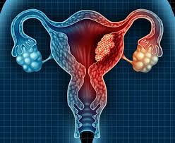 Rahim Kanseri (Endometrial Kanser)